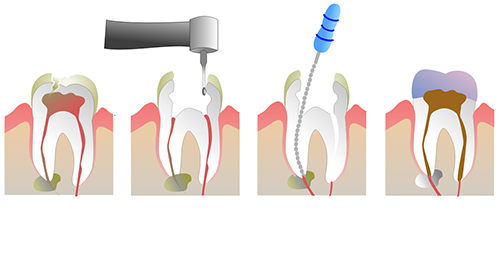 highfive endodontics